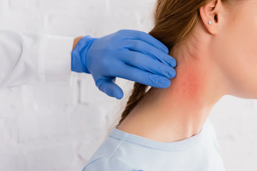 Doctor wearing blue gloves checking a patient’s red rash on the neck caused by an allergic reaction at ER Katy in Katy, TX.