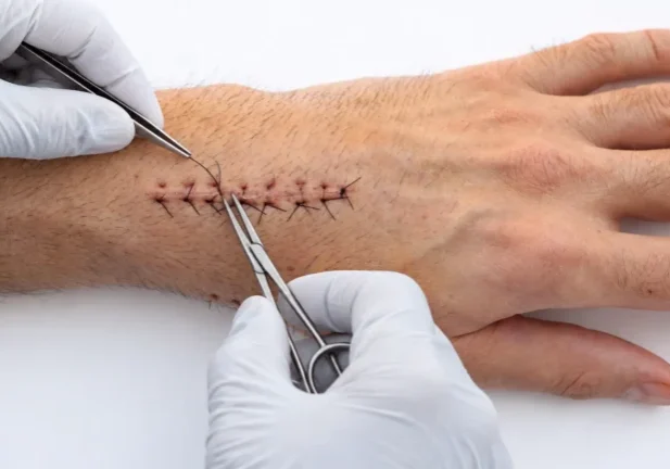 When does a cut need ER stitches