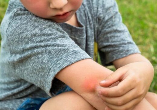 When to go to ER for Bug Bite