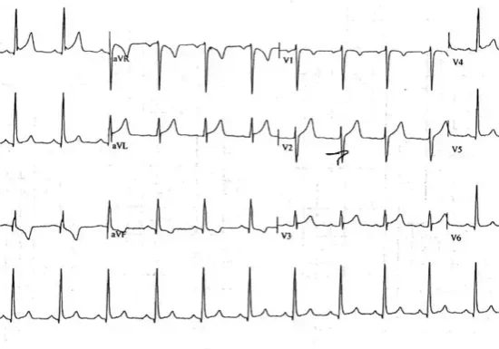 article-Pericarditis