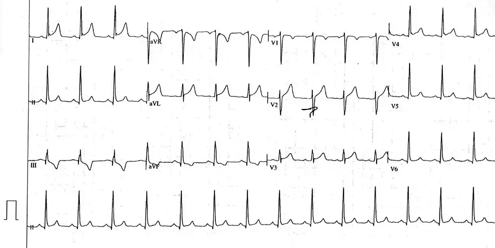 article-Pericarditis article-Pericarditis